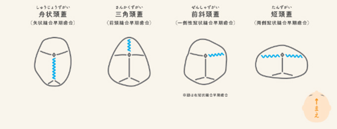 頭蓋縫合早期癒合症の種類のイラスト